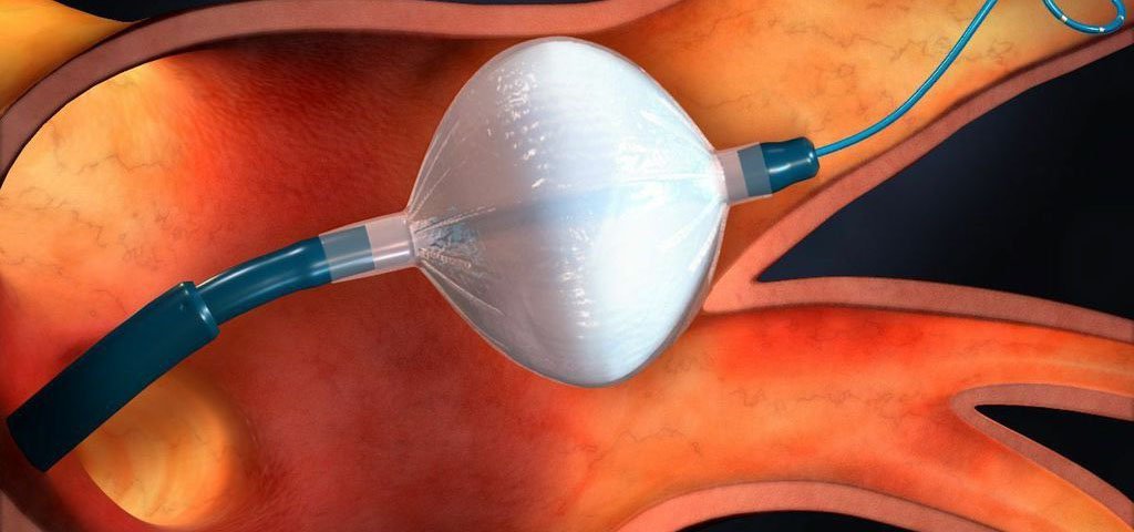 Szívritmuszavar: Műtét fagyasztásos eljárással Zalaegerszegen
